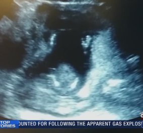 Το βίντεο της ημέρας που έγινε viral σε χρόνο ρεκόρ - Έμβρυο χτυπά παλαμάκια στην κοιλιά της μητέρας του!