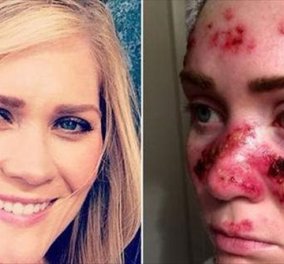 Απίστευτο story: Να πως γέμισε καρκινώματα στο πρόσωπο της που φοβίζει η όμορφη 27χρονη από το συχνό solarium