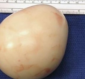 Απίστευτο - Δείτε ένα τεράστιο βραστό αυγό που είχε μέσα του 20 χρόνια - έτρεχε συνέχεια στην τουαλέτα!