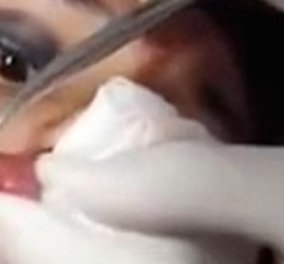 Βίντεο: Αφαίρεσαν ολόκληρο σκουλήκι από τα χείλη της κοπέλας - Λίγο ανατριχιαστικό  