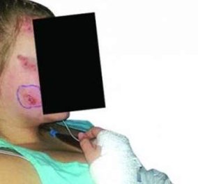 Πάτρα: 35χρονη μητέρα δέχθηκε «επίθεση» μεγάλης τσούχτρας - Τη σημάδεψε στο πρόσωπο