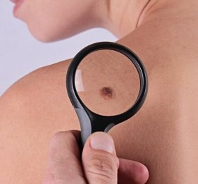 Η αλφαβήτα του μελανώματος: Η πιο επικίνδυνη μορφή καρκίνου του δέρματοςς θεραπεύεται αν…