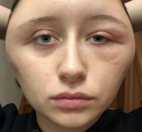 Πως η 19χρονη Γαλλιδούλα παραμορφώθηκε από βαφή μαλλιών – Η αλλεργική αντίδραση σε ένα συνηθισμένο προϊόν
