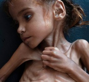 Παγκόσμια συγκίνηση: Η 7χρονη Αμάλ «έφυγε» από τη ζωή - Έγινε σύμβολο του λιμού στην Υεμένη