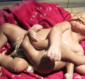 Ινδία: Μωρό με... 8 άκρα, θεωρείται μετενσάρκωση θεού επί της Γης - Το ονόμασαν «Αγόρι Θεό» και μιλούν για θαύμα! 