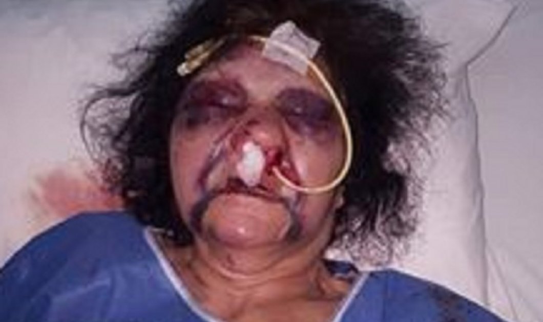 Συγκλονιστική φωτό: 80χρονη έπεσε θύμα άγριου ξυλοδαρμού στη Ρόδο - Τι καταγγέλλει ο γιος της - Κυρίως Φωτογραφία - Gallery - Video